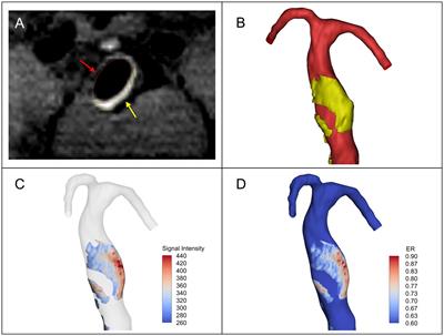 Aneurysm wall enhancement, hemodynamics, and morphology of intracranial fusiform aneurysms